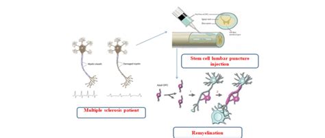 Use of stem cells to repair multiple sclerosis | Download Scientific ...