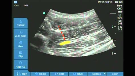 Ultrasound guided anterior sciatic nerve block - YouTube