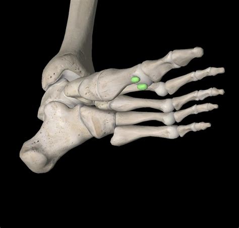 Sesamoiditis - Footcare Scotland