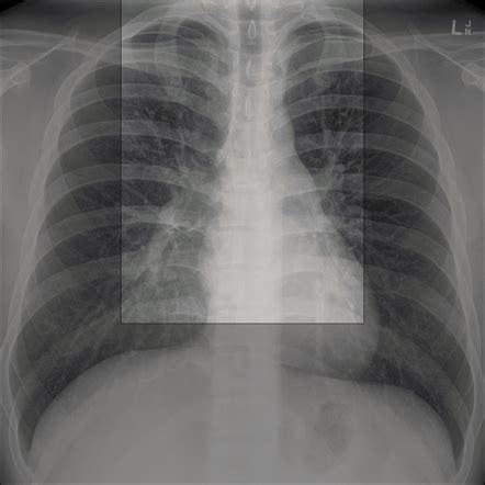 Chest x-ray review: ABCDE | Radiology Reference Article | Radiopaedia.org