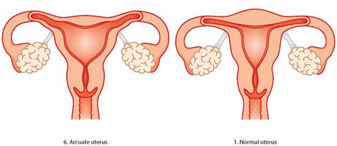 Congenital Uterine Abnormality - Problems With The Womb | Tommy's