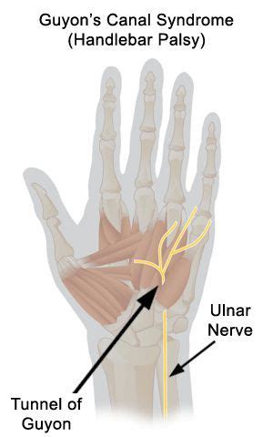 Guyon's Canal Syndrome from stretching or compressing the ulnar nerve Occupational Therapy ...