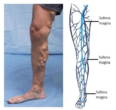 Safenectomía: qué es, técnica, complicaciones, recuperación