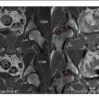 MRI results of Patient 2 (coronal views). T1 coronal sequential views ...