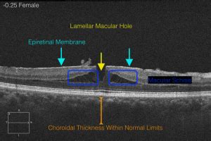 Lamellar Macular Hole - Labelled OCT - EyeCarePD