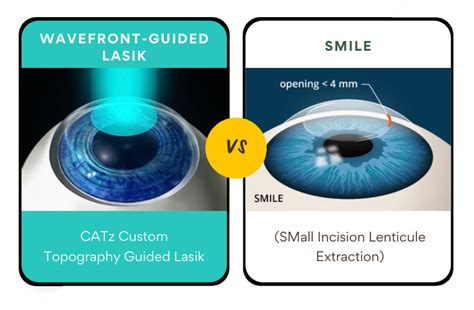 Smile vs. Wavefront-guided Lasik | Top Michigan Lasik Eye Surgery | Yaldo Eye Center | (248) 553 ...