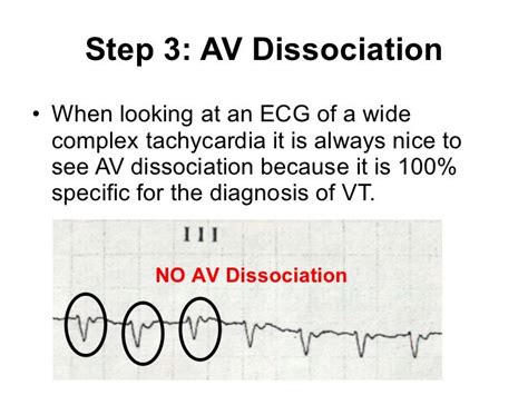 ECG: Fascicular VT