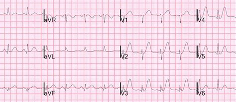 Dr. Smith's ECG Blog: Hyperacute T-waves, with a Twist