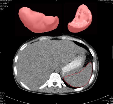 A CT scan of the abdomen and the 3D reconstructed image of the spleen ...