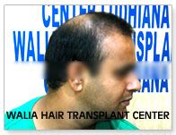 Tim McGraw Hair Transplant - Walia Hair Transplant