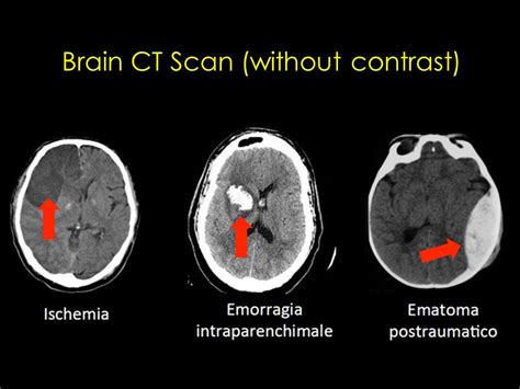 Normal Brain Ct Scan With Contrast