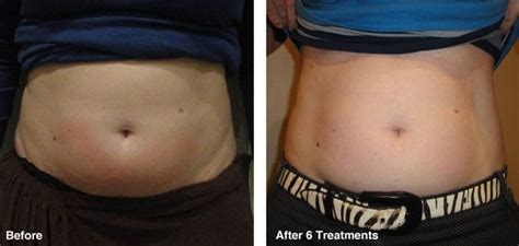 before-after-body-contouring2 – The Global Beauty Group