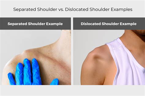 Separated Shoulder vs. Dislocated Shoulder | AOS