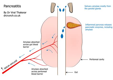 Pitfalls of using amylase to confirm pancreatitis – Dr Crunch Blog