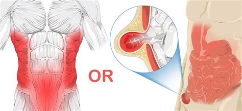 How To Know If Your Abdominal Strain Is A Hernia? – Page 1 – Everyday Medical