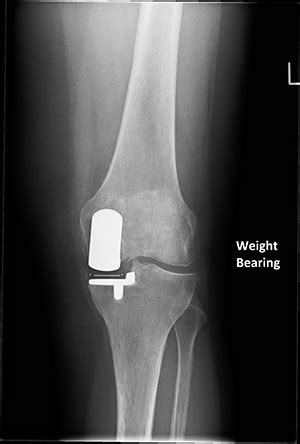 Unicondylar Knee Joint Replacement | Buckinghamshire knee surgery