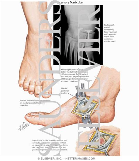 Accessory Navicular