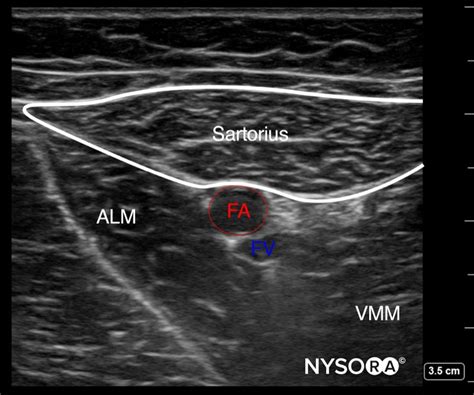 FA, femoral artery; FV, femoral vein; ALM, adductor longus muscle; VMM, vastus medialis muscle.