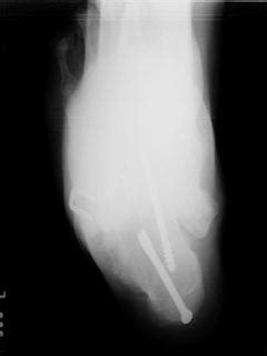 Pes Cavovarus Surgery | Musculoskeletal Key