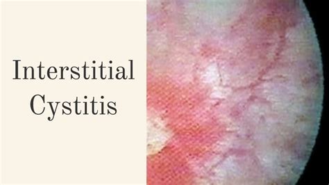 Interstitial Cystitis: Definition, Symptoms, Causes, Diagnosis ...