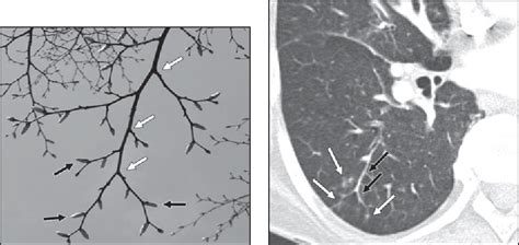 Figure 2 from Tree-in-bud pattern. | Semantic Scholar