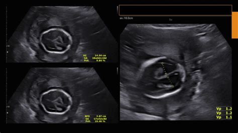 Spina Bifida Ultrasound 20 Weeks