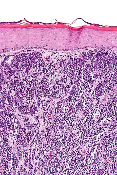 Merkel cell carcinoma - Libre Pathology