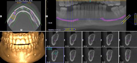 Dental CT Scan Justification: Ensuring Patient Safety and Effective ...