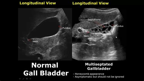 Abnormal, Ultrasound, Pathology, Comparison, Appearance, Ann, Health ...