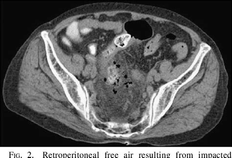 Figure 1 from Rectal Stercoral Ulcer Perforation | Semantic Scholar