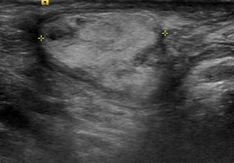 Liposarcoma of the Testis and Spermatic Cord