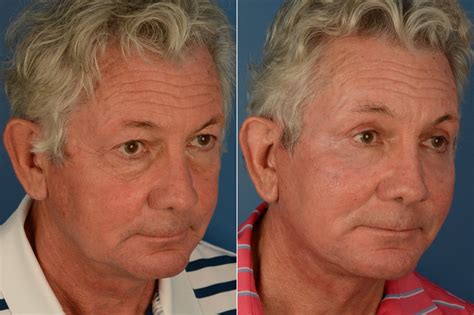 Blepharoplasty, Blepharoplasty Male Photos | Naples, FL | Patient 19157