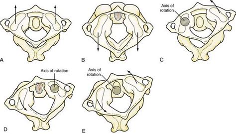 Atlantoaxial Rotatory Subluxation, Transverse Ligament Injury ...