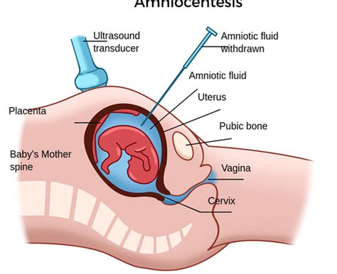 Amniocentesis - Labster