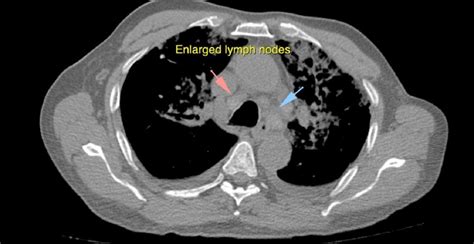 The figure shows a coronal image of CT Scan showing multiple enlarged ...