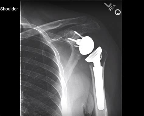 Reverse Total Shoulder Arthroplasty — OrthopaedicPrinciples.com