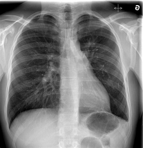 Endobronchial carcinoid tumor | Radiology Case | Radiopaedia.org | Congestive heart failure ...