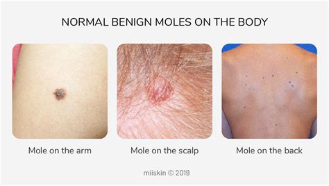 Types Of Moles On The Body