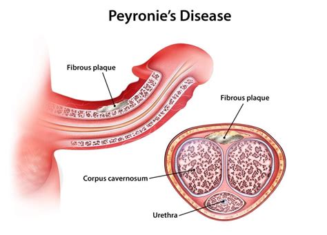 CURVATURA PENEANA ( CONGÉNITA O ENFERMEDAD DE PEYRONIE? )