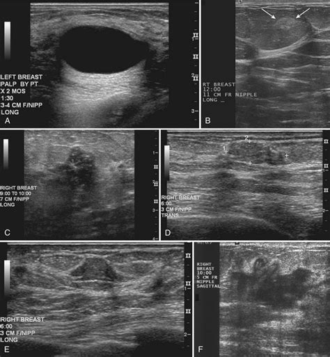 Breast Ultrasound Radiology Key