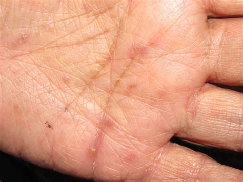 Scabies: Scabies Symptoms & Treatments