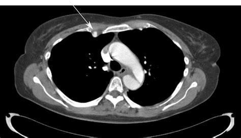 The white arrow is pointing to the right internal mammary artery ...