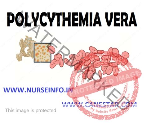 POLYCYTHEMIA VERA - Nurse Info