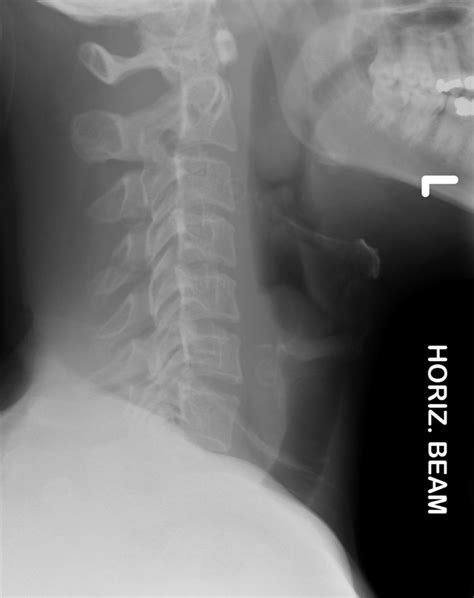 Transverse Process Fracture X Ray