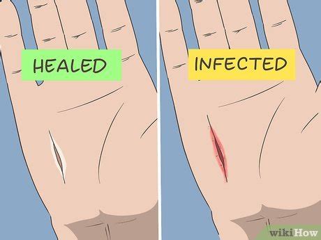 How to Prevent a Cut from Getting Infected (Nurse-Reviewed Guide)