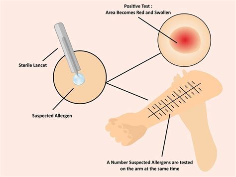 Skin Prick Testing - Dr. Ankit Parakh