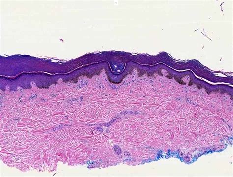 Pathology Outlines - Melanotic macule