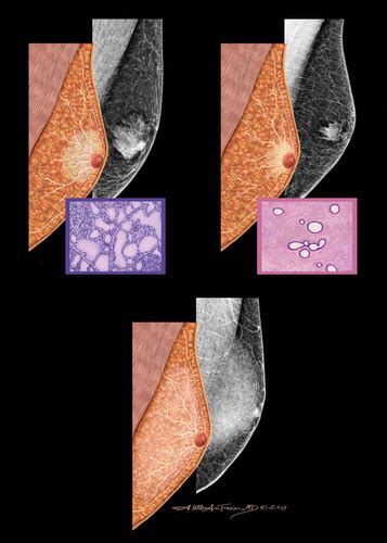 Male Gynecomastia Ultrasound