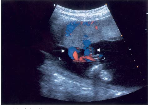 Figure 2 from The Role of Ultrasound in Diagnosing and Managing a Monochorionic-Monoamniotic ...