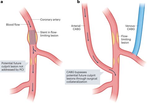 Consensus recommendations for imaging of coronary artery stenosis and atherosclerosis